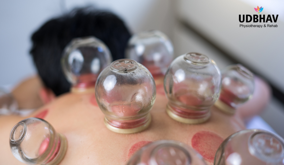 Cupping and Needling Therapy